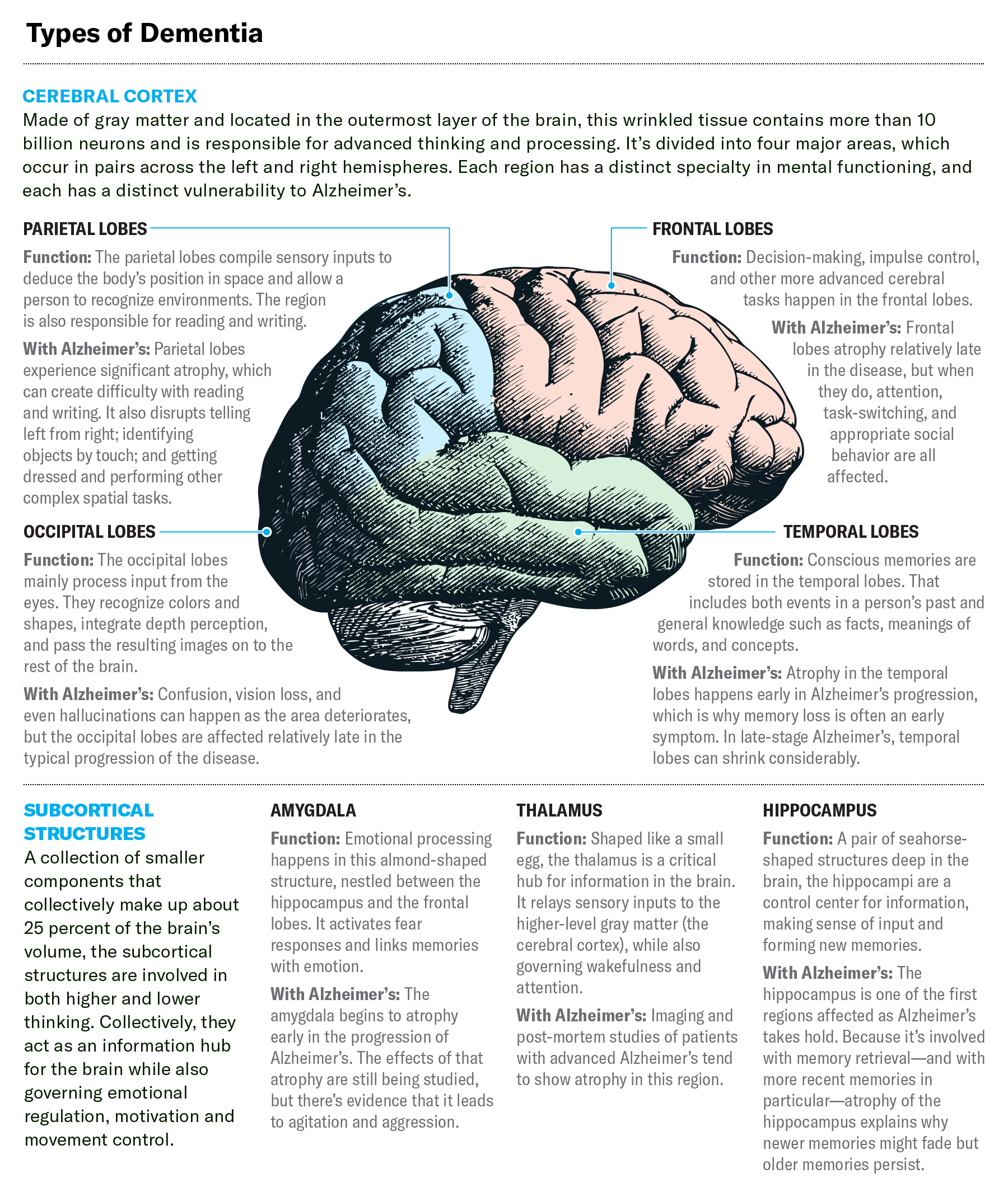 Stages Alzheimers Brain Stages Alzheimers Brain